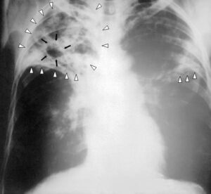 TB in India: Fighting a Poverty-Driven Epidemic