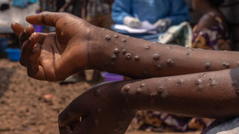 Mpox in Burundi and Global Aid Efforts