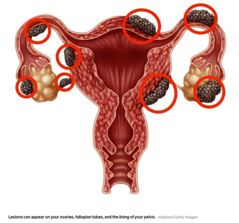 Endometriosis in Uganda: A Silent Crisis and the Power of NGOs