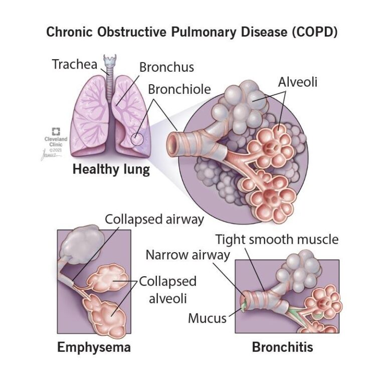 COPD Underdiagnosis in Latin America: Challenges and Solutions